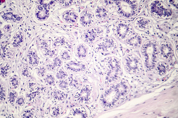 Hard breast cancer, light micrograph, photo under microscope