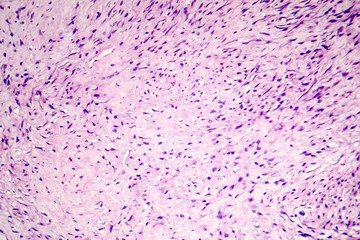 Fibroma, a benign tumour of fibrous tissue, light micrograph, photo under microscope