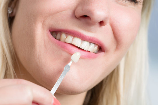 Zahnfarbe für Zahnersatz am Mund einer Frau aussuchen