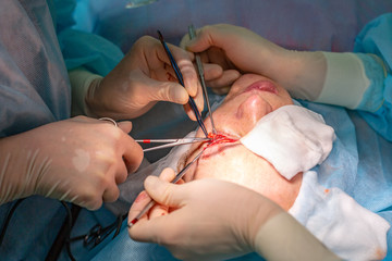 Plastic surgery in the operating room. Blepharoplasty