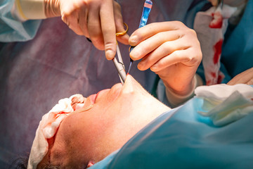Plastic surgery in operating room. Circular face lift
