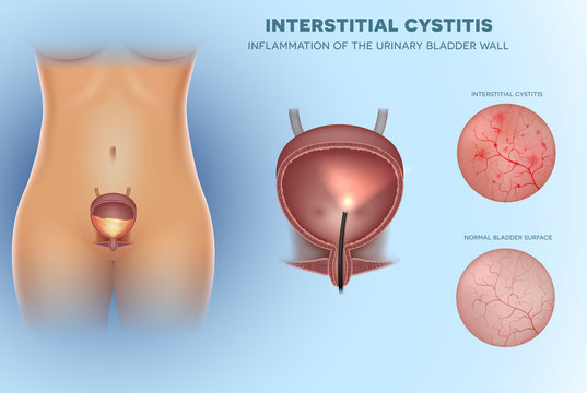 Inflammation of the urinary bladder Cystitis, interior lining closeup illustration