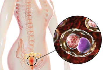 Female chlamydiosis, medical concept. 3D illustration showing close-up view of Chlamydia trachomatis bacteria infecting cells of cervix uteri - obrazy, fototapety, plakaty