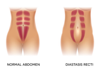 Diastasis recti also known as abdominal separation, it is common among pregnant women. There is a gap between the rectus abdominis muscles.