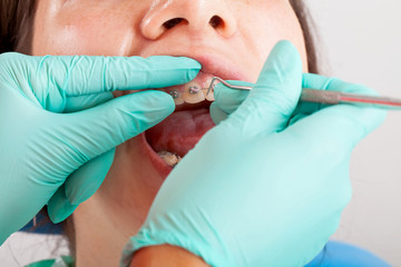 Woman with dental braces