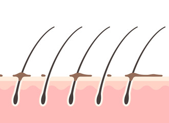 汚れた頭皮の断面図