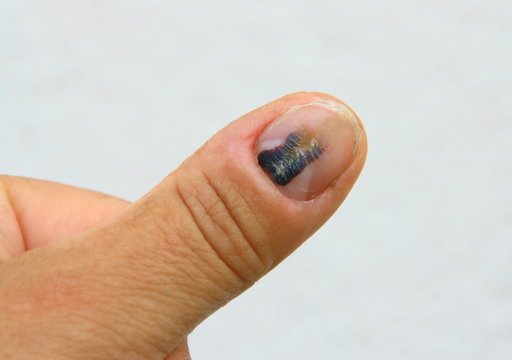 h&eacute;mat&ocirc;me sur l'ongle du pouce de la main