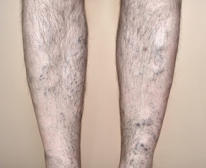 Legs of a man with varicose veins and capillaries
