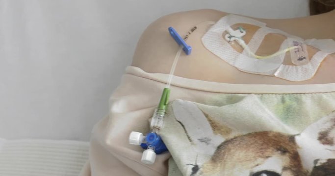 A woman lies in a post-operative room on a hospital bed. The catheter protrudes from the arm. Rests after surgery. Panning camera