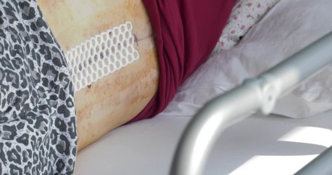 A young girl lies in a post-operative room on a hospital bed. It has a special honeycomb dress. Rests after spine surgery, scoliosis. Closeup,