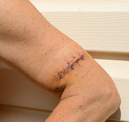 Recent suture of lacerated wound on man arm.