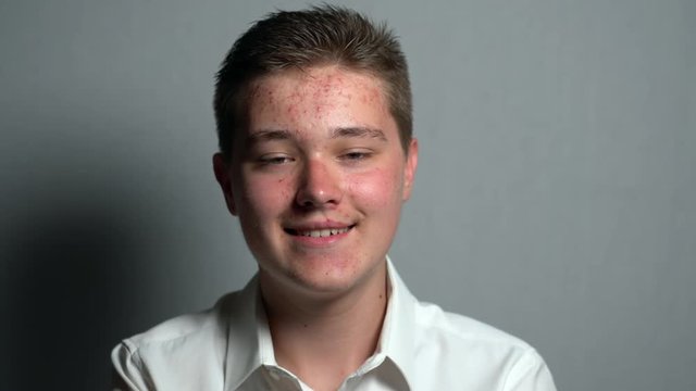 Portrait of a young happy man with a dermatology problem of skin facce looking at the camera. Dermatological problems in a teenager. Young guy in a transitional age.