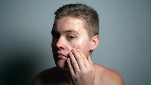 Young man with dermatology acne problems looking at the camera in the studio on the grey background. Guy smiling and touching his allergic face skin.