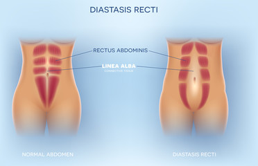 Diastasis Recti also known as Diastasis Rectus Abdominus or abdominal separation, it is common among pregnant women and post birth. There is a gap between the rectus abdominis muscles.