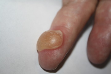Burns on finger