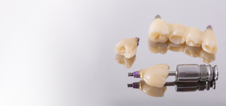 Tooth human implant. Dental concept. Ceramic human teeth or dentures. Implants on mirror background closeup