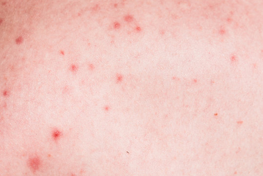 Acne on the skin of the back close-up - macro