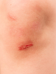 wound on the child's knee