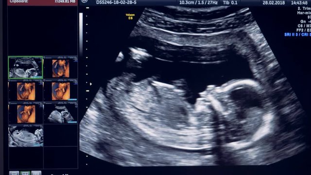 Ultrasound monitor with a small baby displayed on it