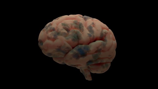 3d render of brain with damage zones. Infection or another reason of brain damage concept. Animation of growing brain damage zone. Isolated.