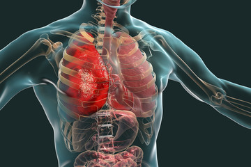 Pneumonia medical concept, 3D illustration showing lobar pneumonia of the right lung - obrazy, fototapety, plakaty