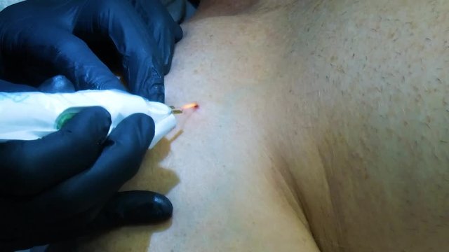 Mole Cherry Angioma Removal