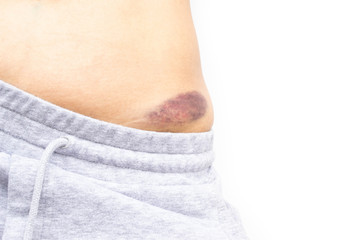 Macro shot of young woman with bruise, hematoma on pelvis