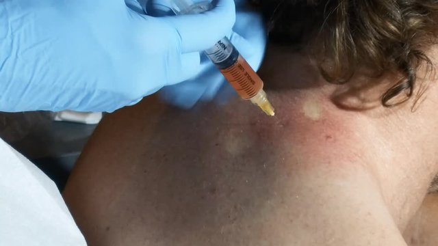 Neck Shoulder Injection