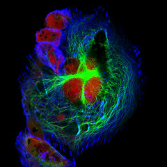 Real fluorescence microscopic view of human neuroblastoma cells