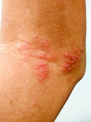 Herpes zoster occurs at the human arm.