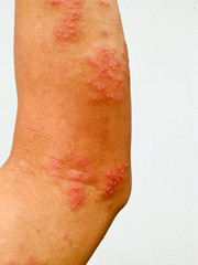 Herpes zoster occurs at the human arm.