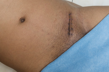 Body part of hernia patient after stitches off with towel. A hernia is the abnormal exit of tissue...