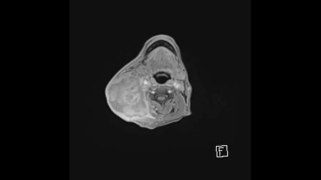 MRI Neck (Lymph node) of Throat cancer smooth motion. Top View