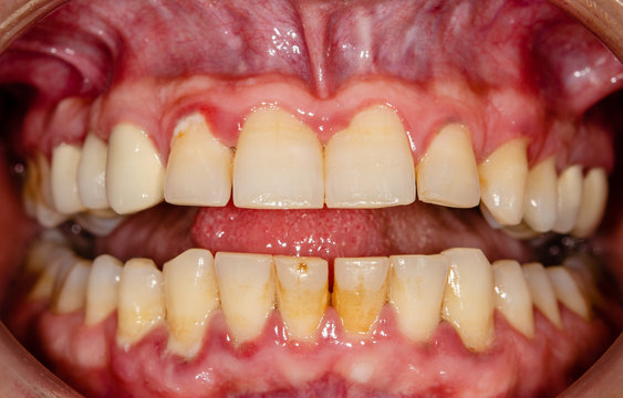 gingivitis, zahnstein, bakterieller belag