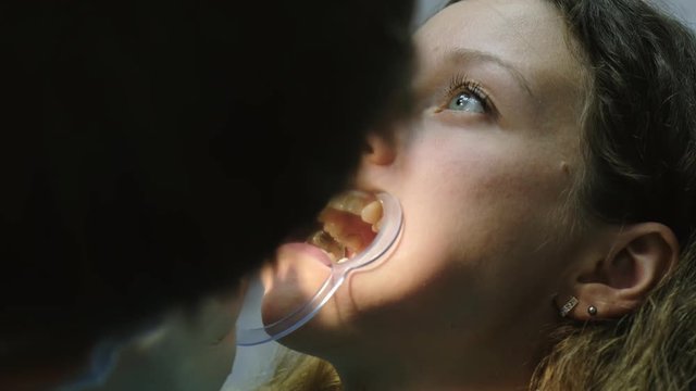 Installation and fixation of the metal bracket system. Visit to the dentist orthodontist, correction of malocclusion