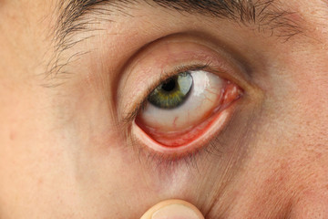 man pulls the lower eyelid to survey the eyeball, closeup macro