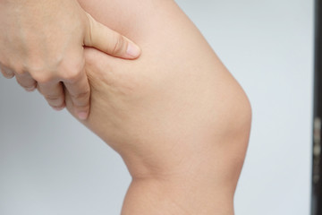 Female legs thighs with cellulite. Skin problem, body care, overweight and dieting concept, diabetic risk factor.