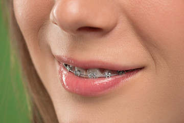 Naklejka premium Beautiful young woman with teeth braces on green