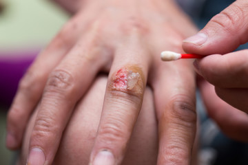 wound on the finger