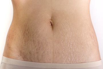 Abdominal scar marked pattern