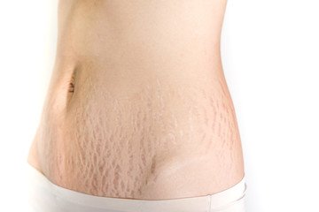 Abdominal scar marked pattern