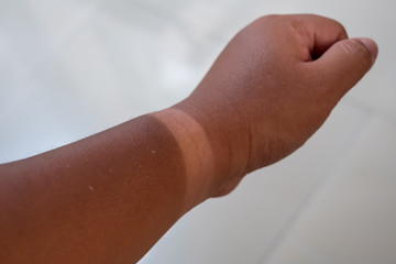 Watch Tan Line on Wrist After Sun Exposure