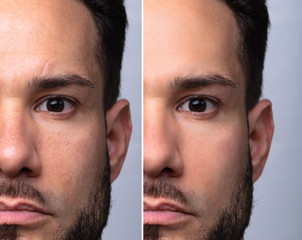 Man's Face Before And After Cosmetic Procedure