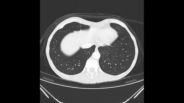 Ct Brain with of Throat cancer. top view