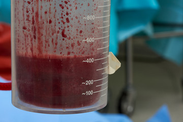 A lot of blood in a suction container