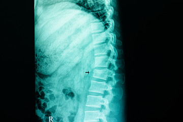 compression fracture of lumbar spine