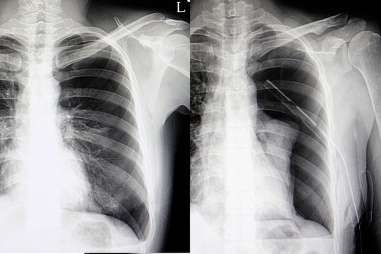 spontaneous pneumothorax chest film