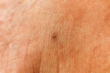Small scab on the surface human.