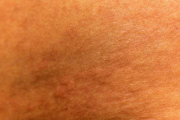 Fototapeta premium Blurred of skin human have red rash from allergies.