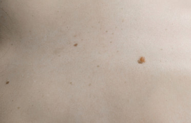 Woman's white skin with moles. View top. Close up back.